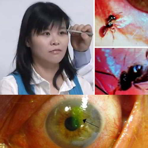 Taiwan Doctor finds four live bees inside a woman's eye dining on her tears …!!!